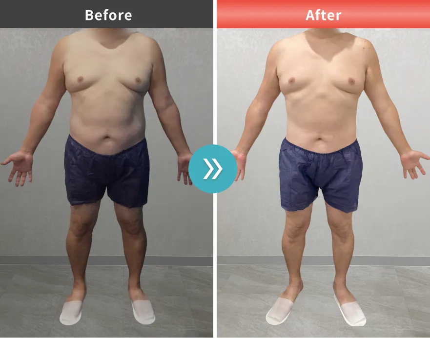 医療痩身・医療ダイエットの症例No.00167｜104.1kg→90.3kg（40代男性・177cm）