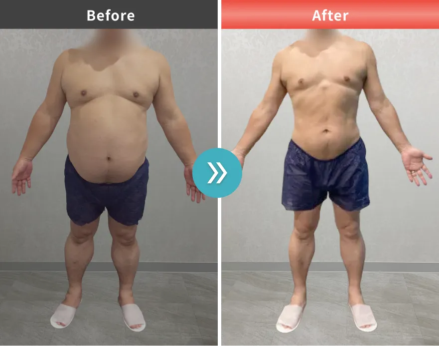 医療痩身・医療ダイエットの症例No.00168｜107.9kg→79.0kg（50代男性・168cm）