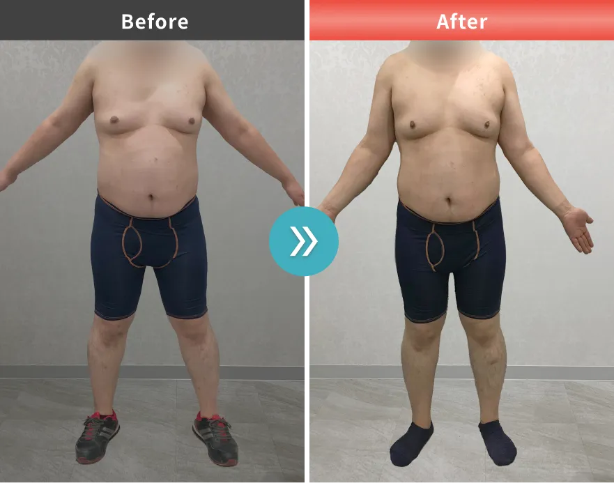 医療痩身・医療ダイエットの症例No.00169｜110.5kg→100.2kg（20代男性・180cm）