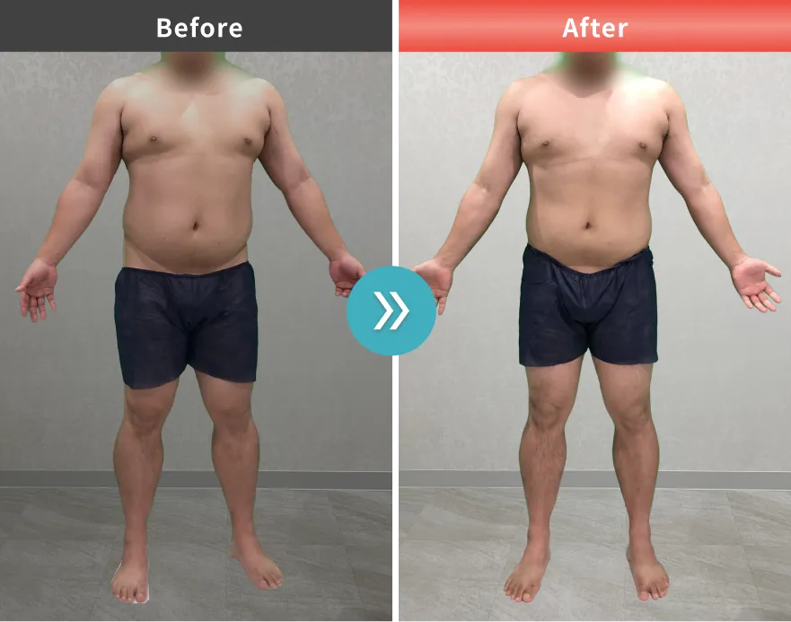 医療痩身・医療ダイエットの症例No.00170｜113.5kg→101.1kg（30代男性・175cm）