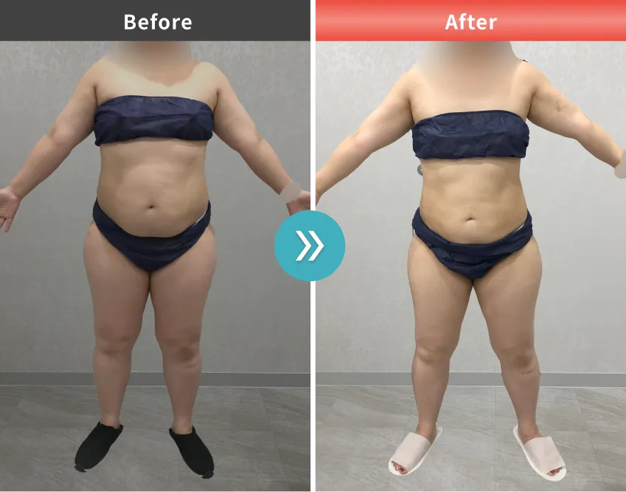 医療痩身・医療ダイエットの症例No.00176｜82.0kg→69.9kg（40代女性・159cm）