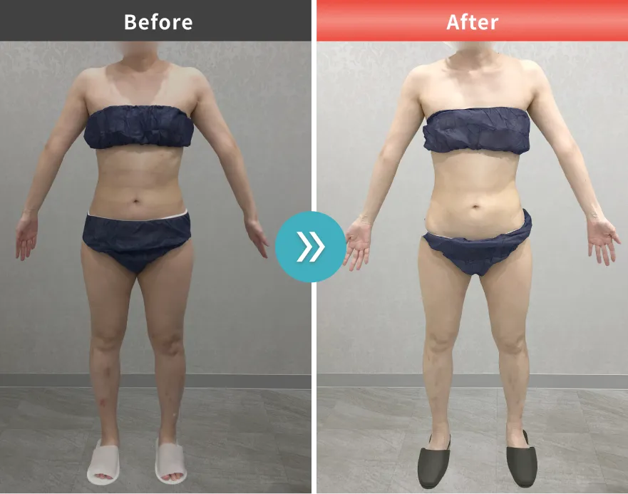 医療痩身・医療ダイエットの症例No.0089｜56.7kg→50.9kg（40代女性・162cm）