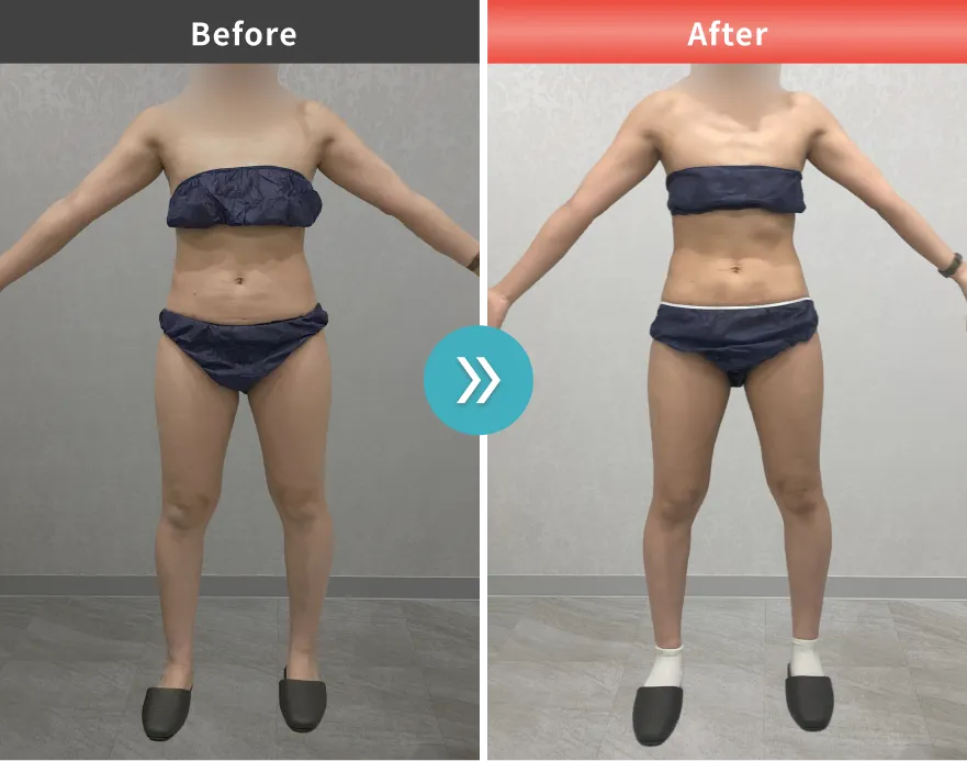 医療痩身・医療ダイエットの症例No.0098｜61.2kg→53.8kg（30代女性・161cm）
