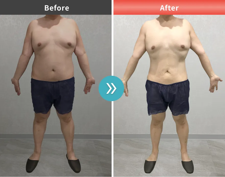 症例No.00182｜110.3kg→89.8kg（40代男性・177cm）