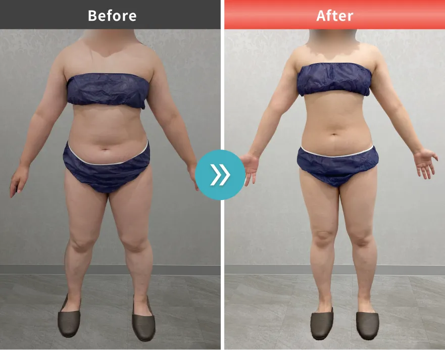 症例No.00190｜73.4kg→62.6kg（30代女性・157cm）
