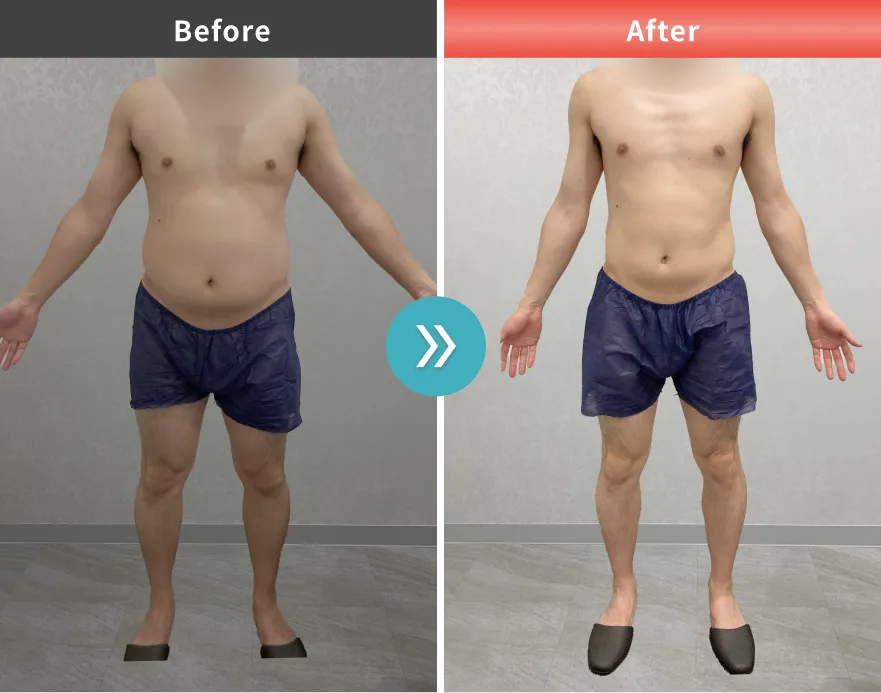症例No.00193｜94.2kg→78.8kg（20代男性・180cm）