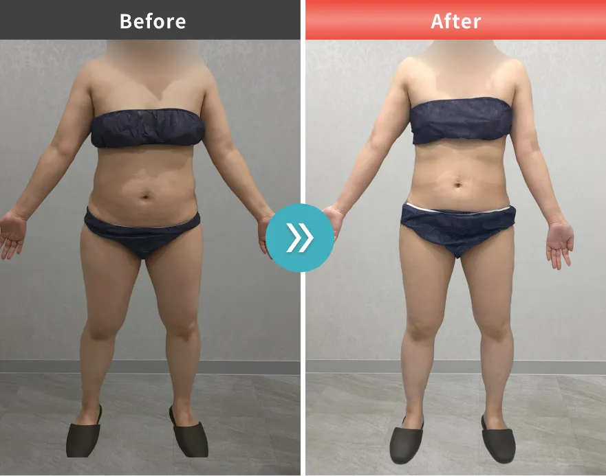 症例No.00195｜72.8kg→62.7kg（30代女性・161cm）