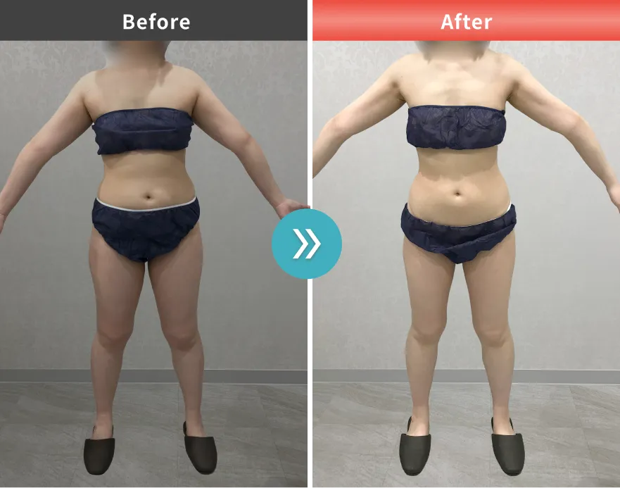 症例No.00196｜65.4kg→55.1kg（30代女性・162cm）
