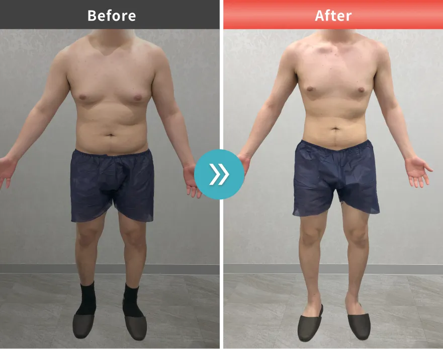 症例No.00198｜93.1kg→71.0kg（20代男性・177cm）