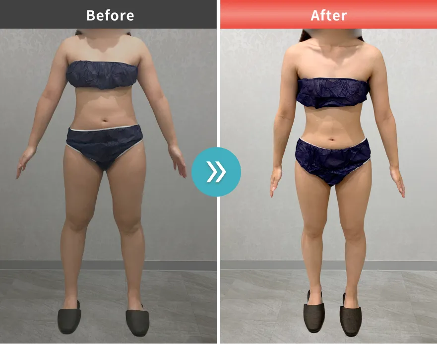 症例No.00199｜61.7kg→49.4kg（20代女性・160cm）