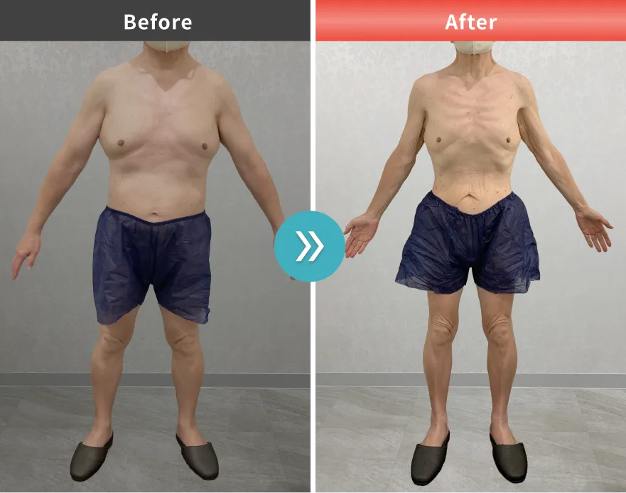 症例No.00201｜69.4kg→54.5kg（60代男性・162cm）