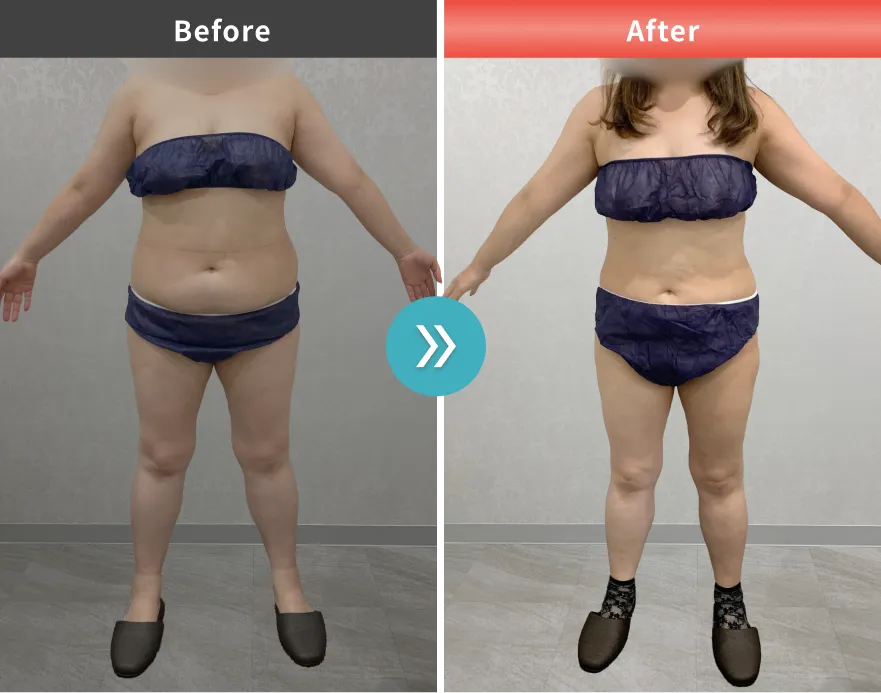 症例No.00202｜67.7kg→61.5kg（40代女性・155cm）