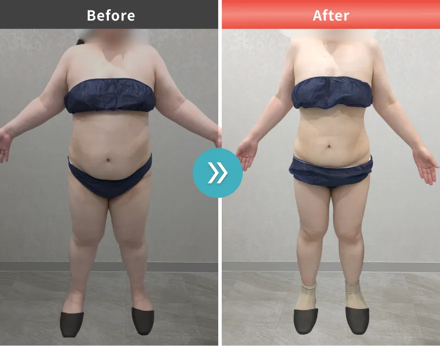 症例No.00203｜95.8kg→68.7kg（30代女性・160cm）