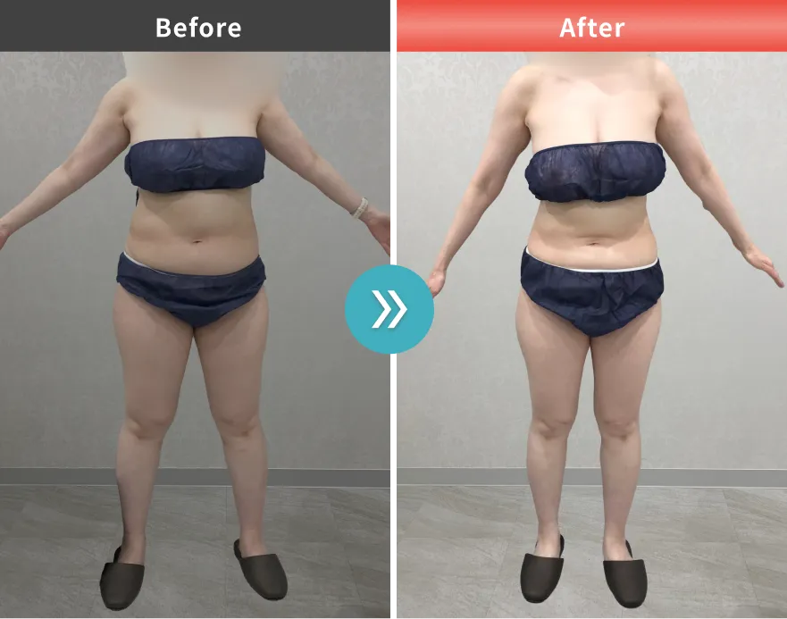 症例No.00205｜63.2kg→54.1kg（40代女性・160cm）