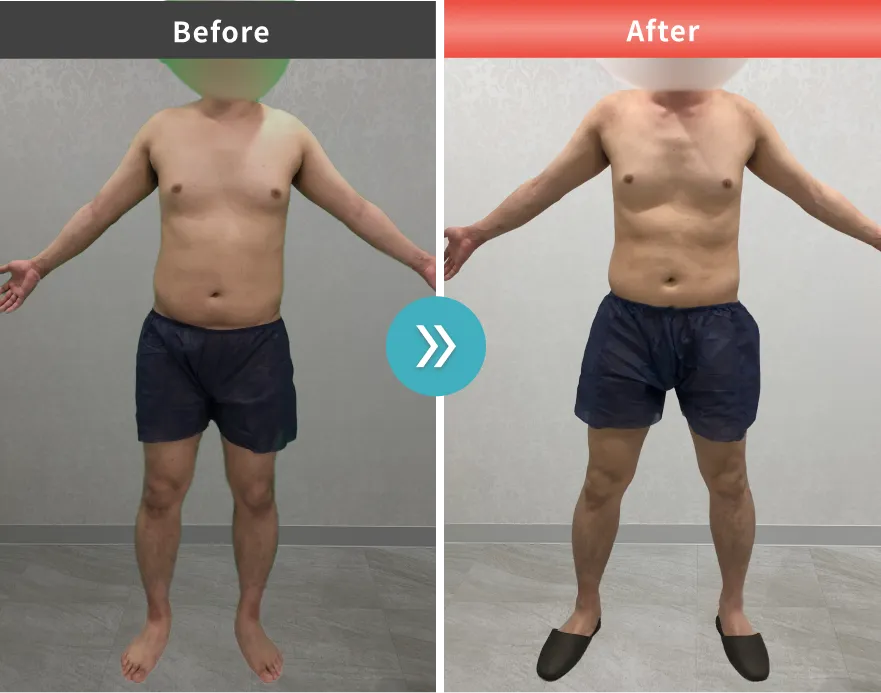 症例No.00207｜78.2kg→72.2kg（20代男性・173cm）